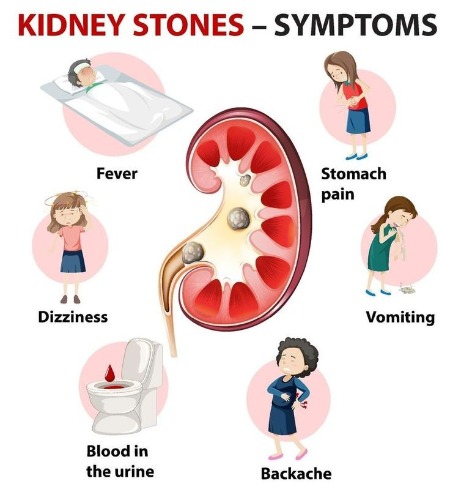 KIDNEY STONES